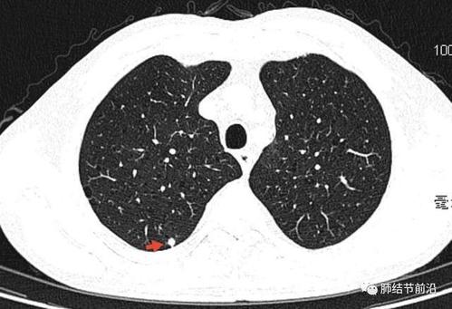 肺结节原位癌是什么意思（肺部非实性结节是什么意思）
