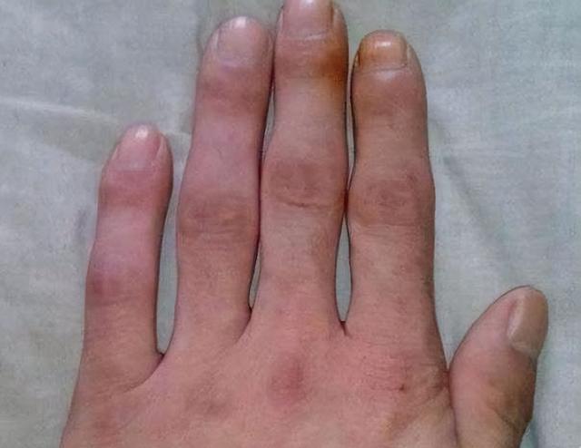 肺癌的15个征兆手指,肺癌的15个征兆手指肿胀