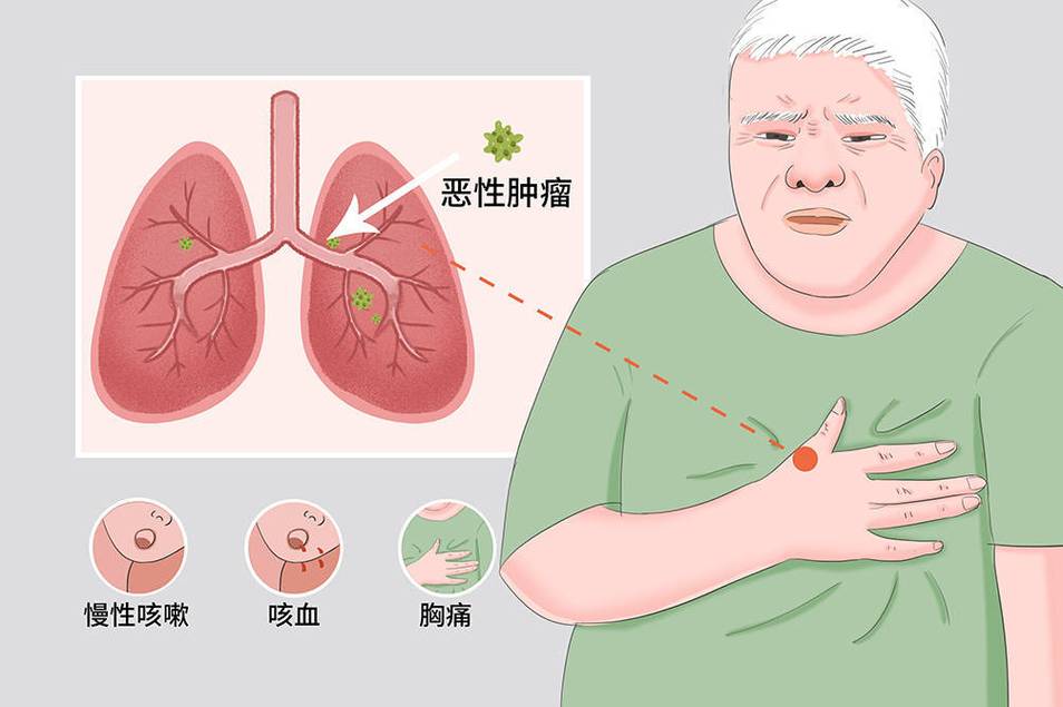 肺癌的早期症状有哪些?4大症状要警惕!一,肺癌的早期症状是什么症状